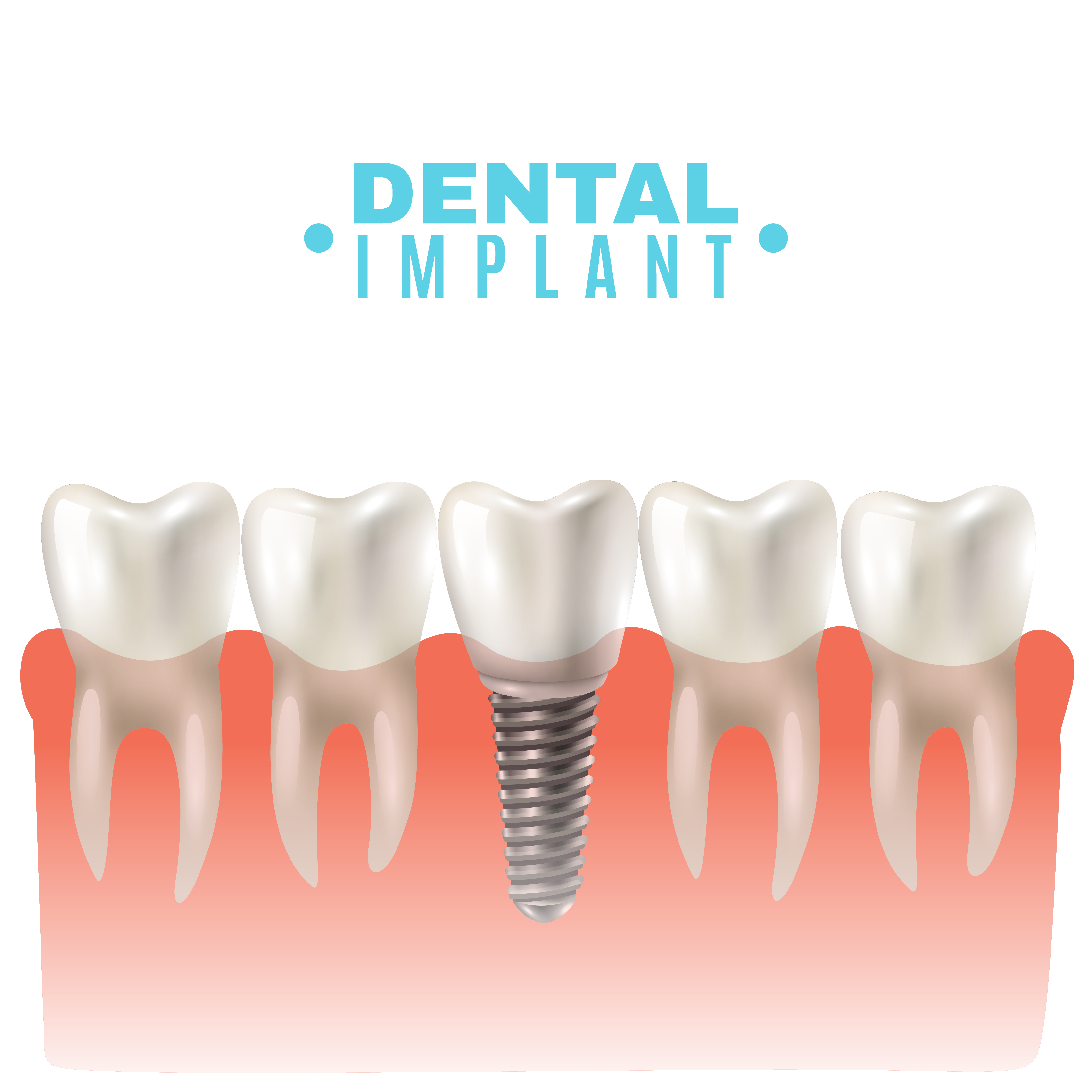 Dental Implants in Hyderabad